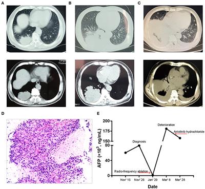 Genomic Profiles of a Patient of Pulmonary Hepatoid Adenocarcinoma With High AFP Level: A Case Report